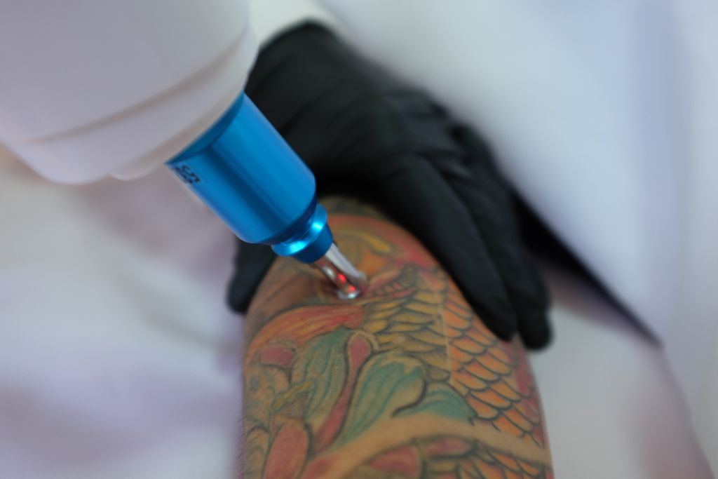 Does Laser Tattoo Removal Hurt? Process, Healing Time and Aftercare Tips